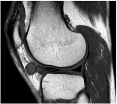 Meniscal cyst 3